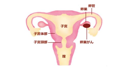 晩婚化・少子化で「卵巣がん」が増えている！早期発見のために、婦人科検診で追加してほしい検査とは_img0