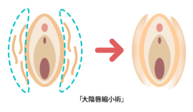 医師が回答 デリケートゾーンのたるみ W形 になると要注意 原因と解決策 Vio脱毛からデリケートゾーンケア 女性の体のことまで もっとおしゃれに大人もナチュラルライフを楽しもう Mi Mollet ミモレ 明日の私へ 小さな一歩 2 2